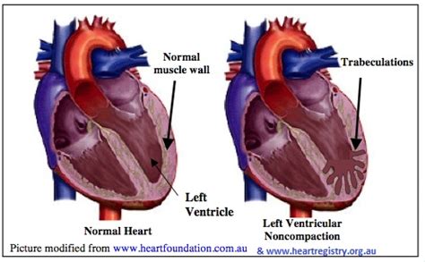 lv compaction|left ventricular non compaction symptoms.